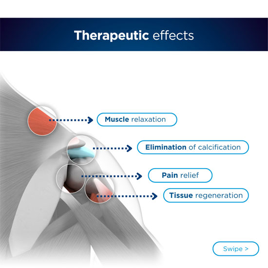 Radiale Stoßwellentherapie