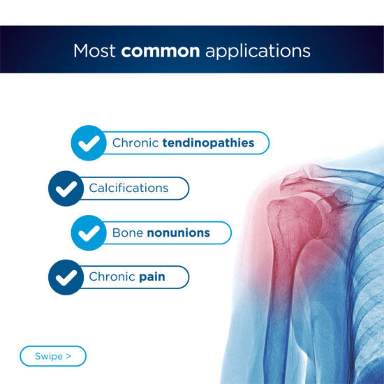 Radiale Stoßwellentherapie