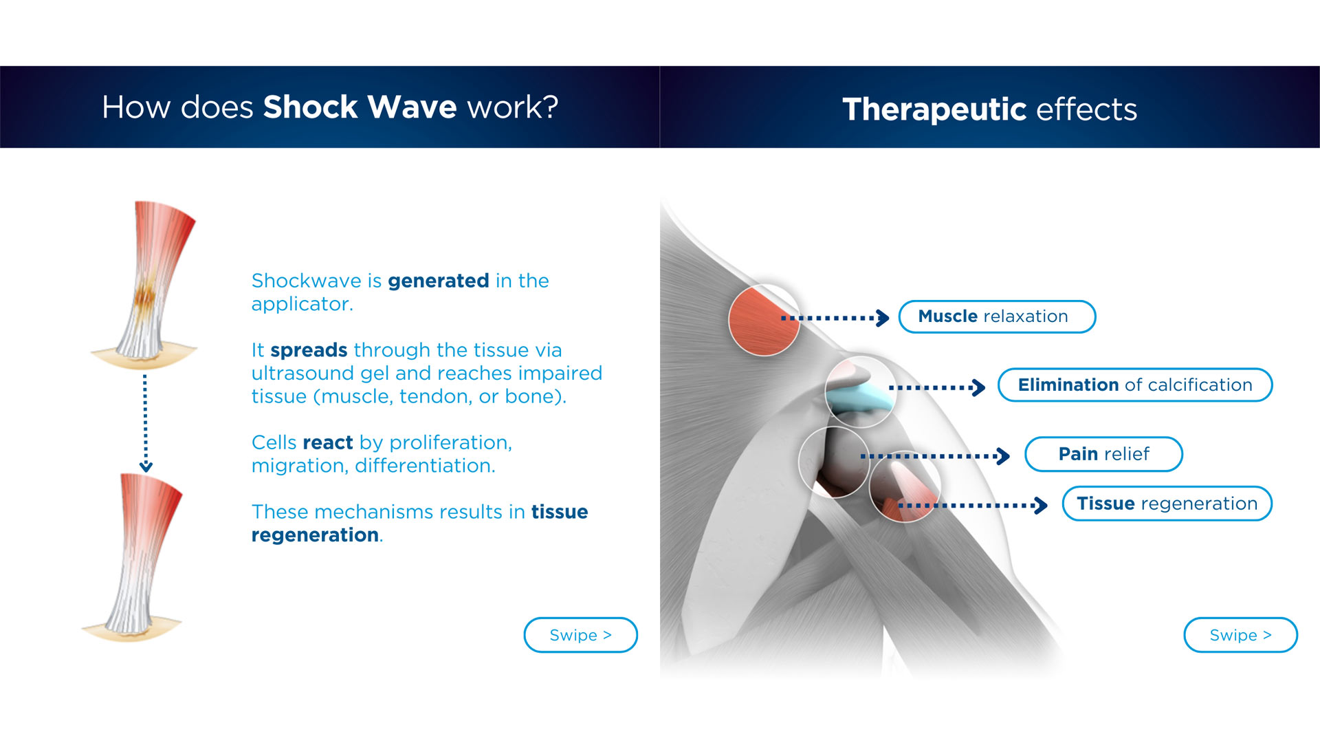 Odaklı Şok Dalga Tedavisi