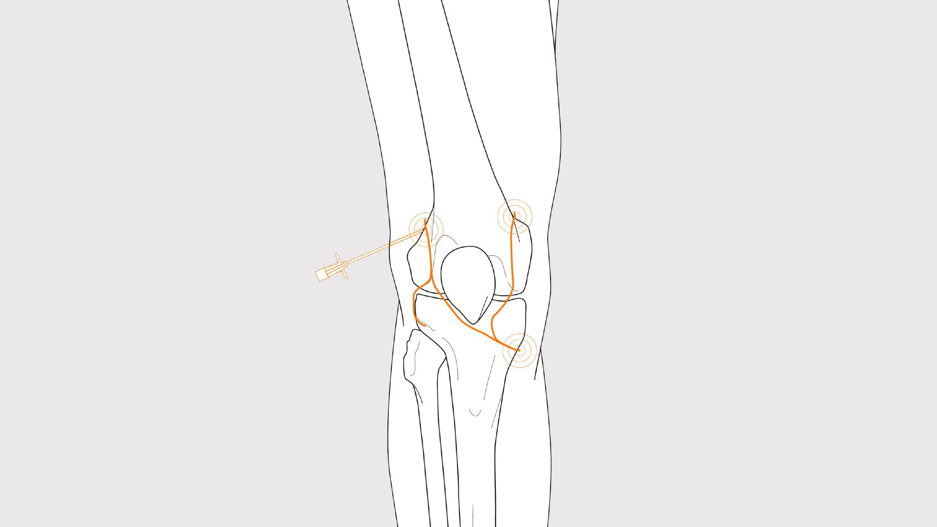 Radyofrekans Ablasyon Tedavisi