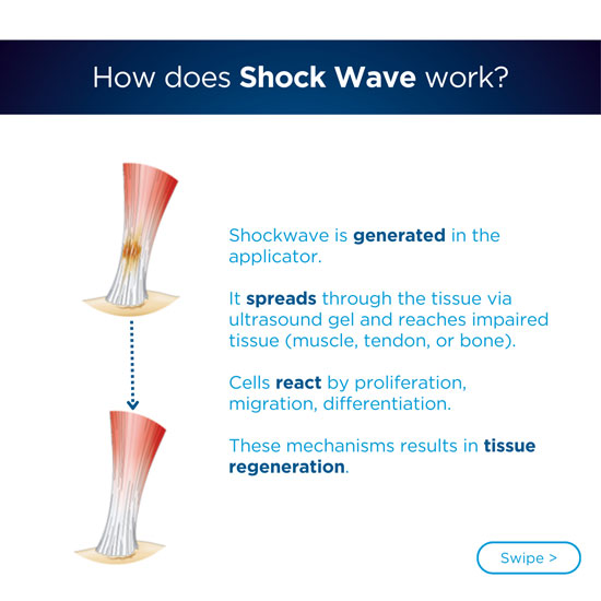 Radiale Stoßwellentherapie